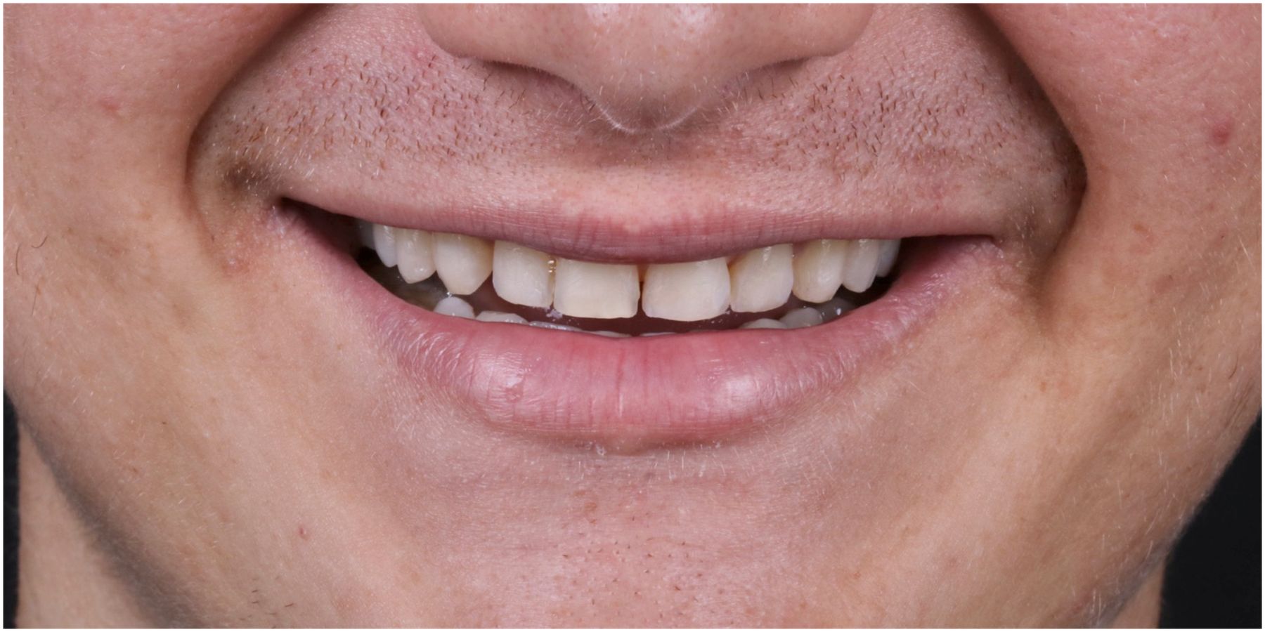Sorriso antes do tratamento