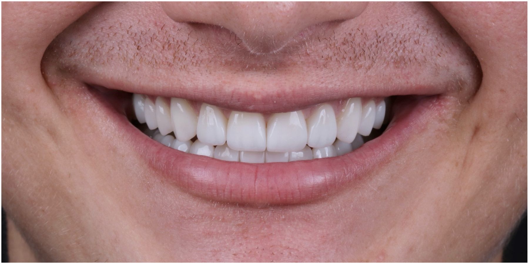 Sorriso depois do tratamento